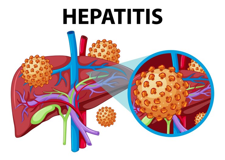 A graphic illustration of the liver with surrounding labels describing Hepatitis. The liver is shown in a healthy state and also in a state affected by Hepatitis, highlighting inflammation and damage.