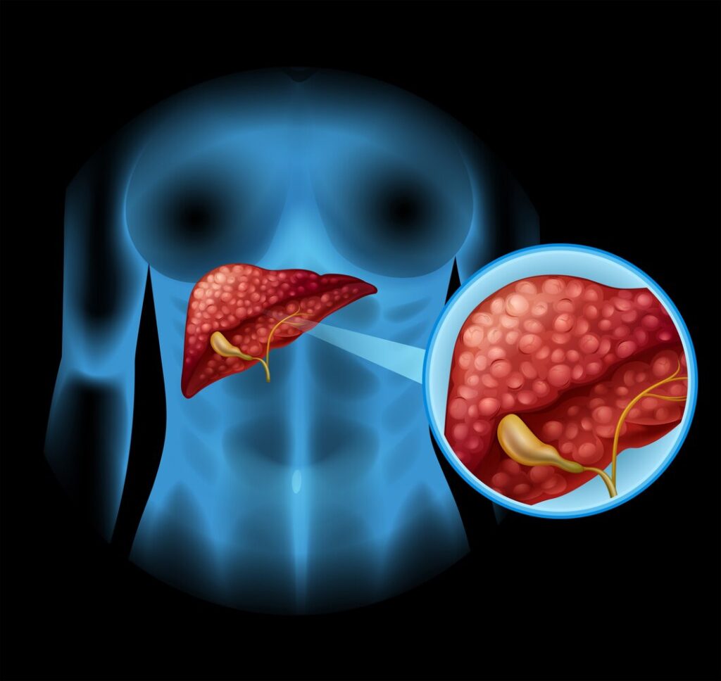 
"Alt text: Illustration depicting a liver with highlighted bile ducts, representing Primary Biliary Cholangitis, a chronic liver disease.