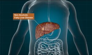 NAFLD