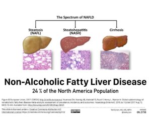 NAFLD