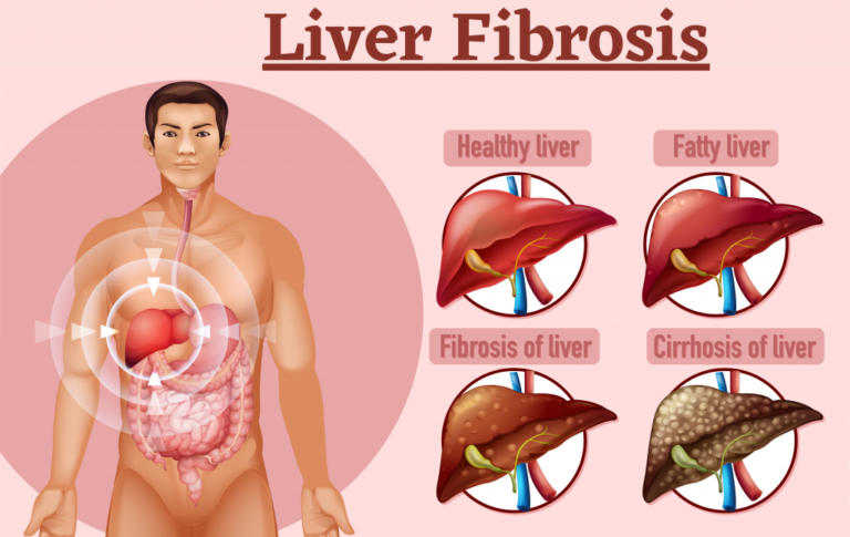 Liver Fibrosis