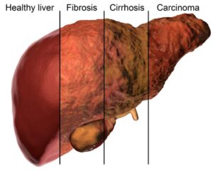 Liver Fibrosis