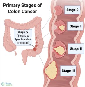 colon cancer