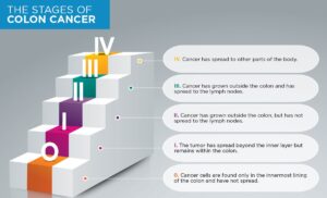 colon cancer