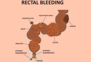 Blood in Stool