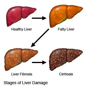 Liver Fibrosis