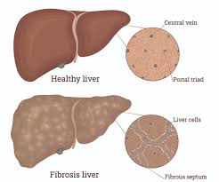 Liver Fibrosis